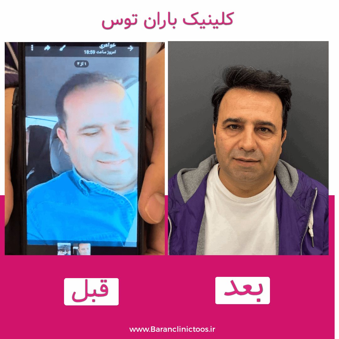 قبل و بعد کاشت مو